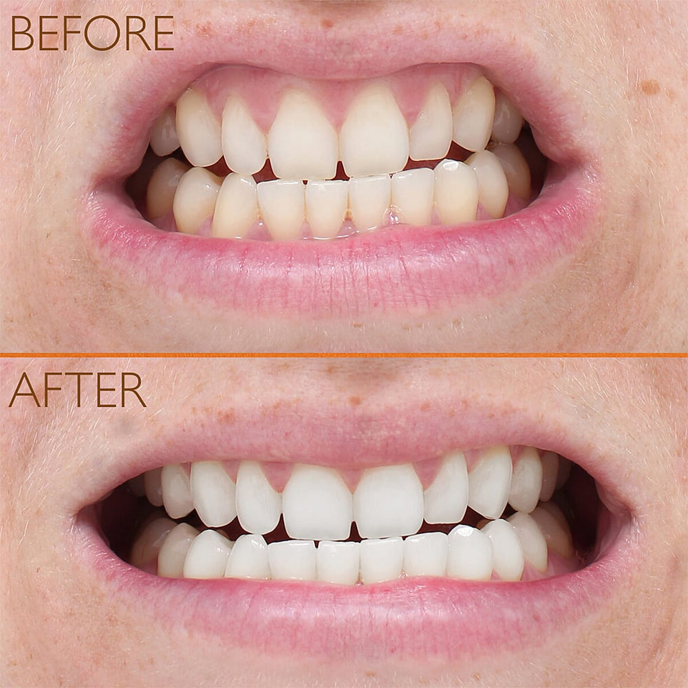 Lab Life Teeth Whitening Trio - Lab Life Beauty Eclipse Whitening System, Whitening Serum and Enamel Serum