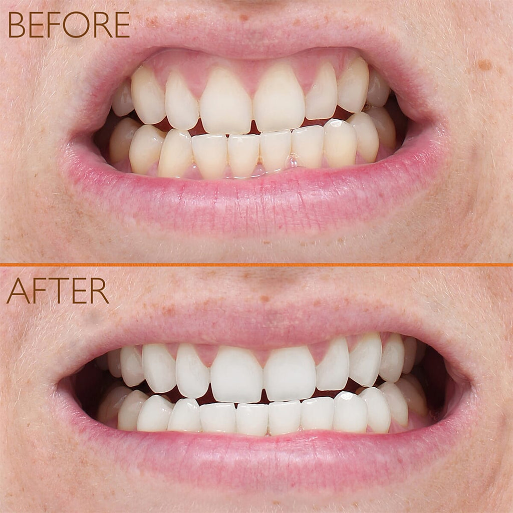 Lab Life Teeth Whitening Trio - Lab Life Beauty Eclipse Whitening System, Whitening Serum and Enamel Serum