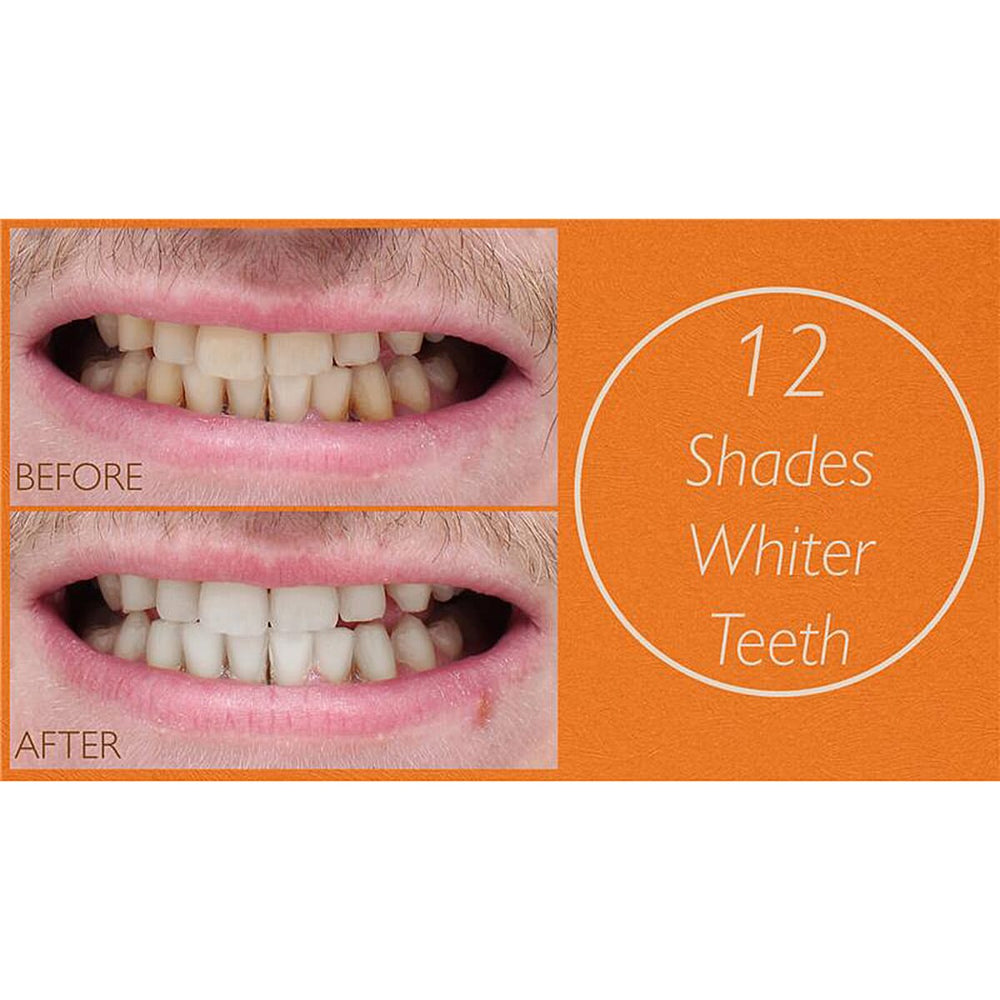 Lab Life Teeth Whitening Trio - Lab Life Beauty Eclipse Whitening System, Whitening Serum and Enamel Serum