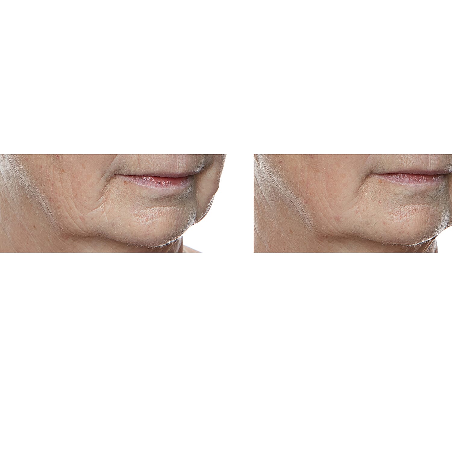 Lab Life Elysium Viscero-Dermal LED Powerful Face Device (660 LED Lights) - Exclusive Lifetime Warranty