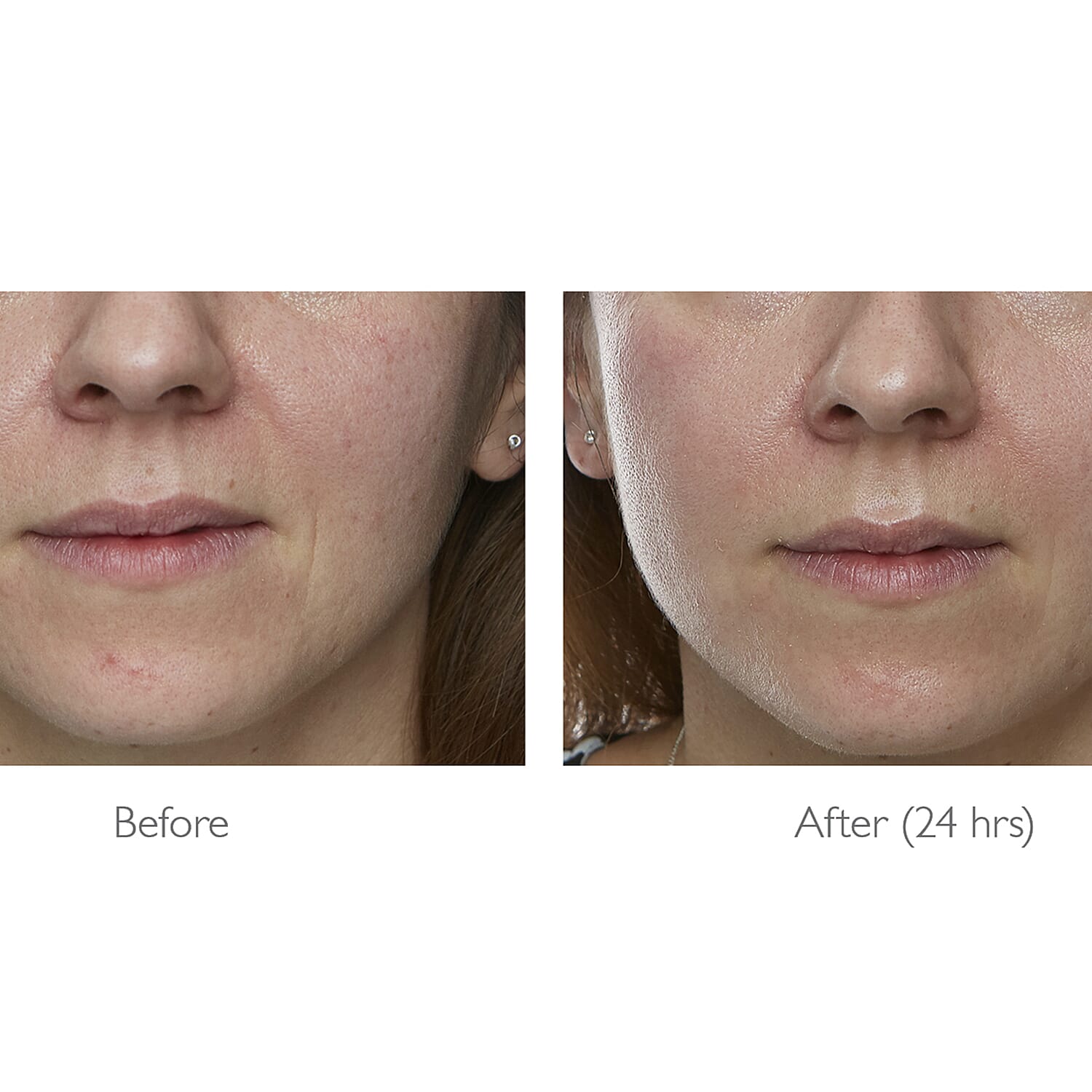 Lab Life Elysium Viscero-Dermal LED Powerful Face Device (660 LED Lights) - Exclusive Lifetime Warranty