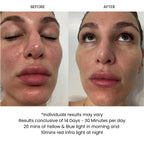 LunaMour AuraLux Advanced LED - Infrared Face Therapy Mask (Lifetime Warranty)
