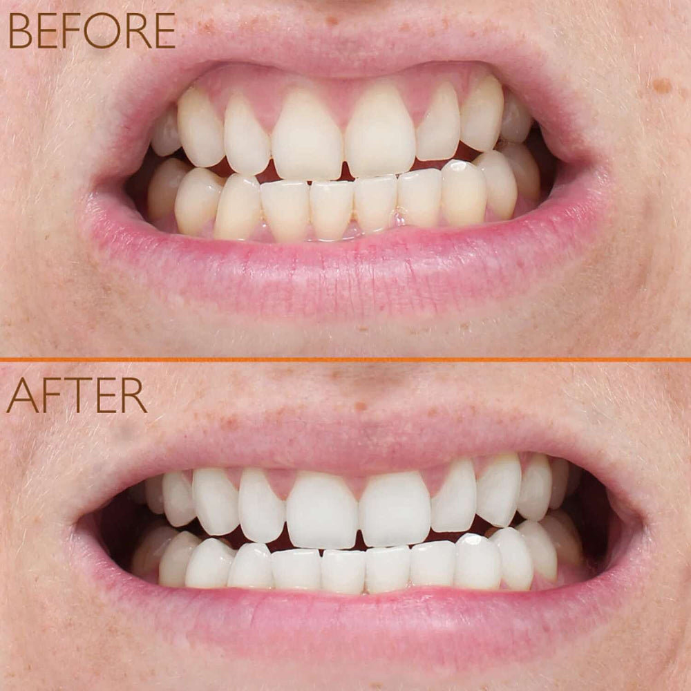 Lab Life Eclipse Whitening System (Incl. Eclipse, UV Charger, Whitening Serum - Enamel Serum)