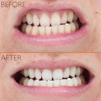 Lab Life Eclipse Whitening System (Incl. Eclipse, UV Charger, Whitening Serum - Enamel Serum)