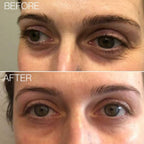 Beautical Microneedle Eye Patches