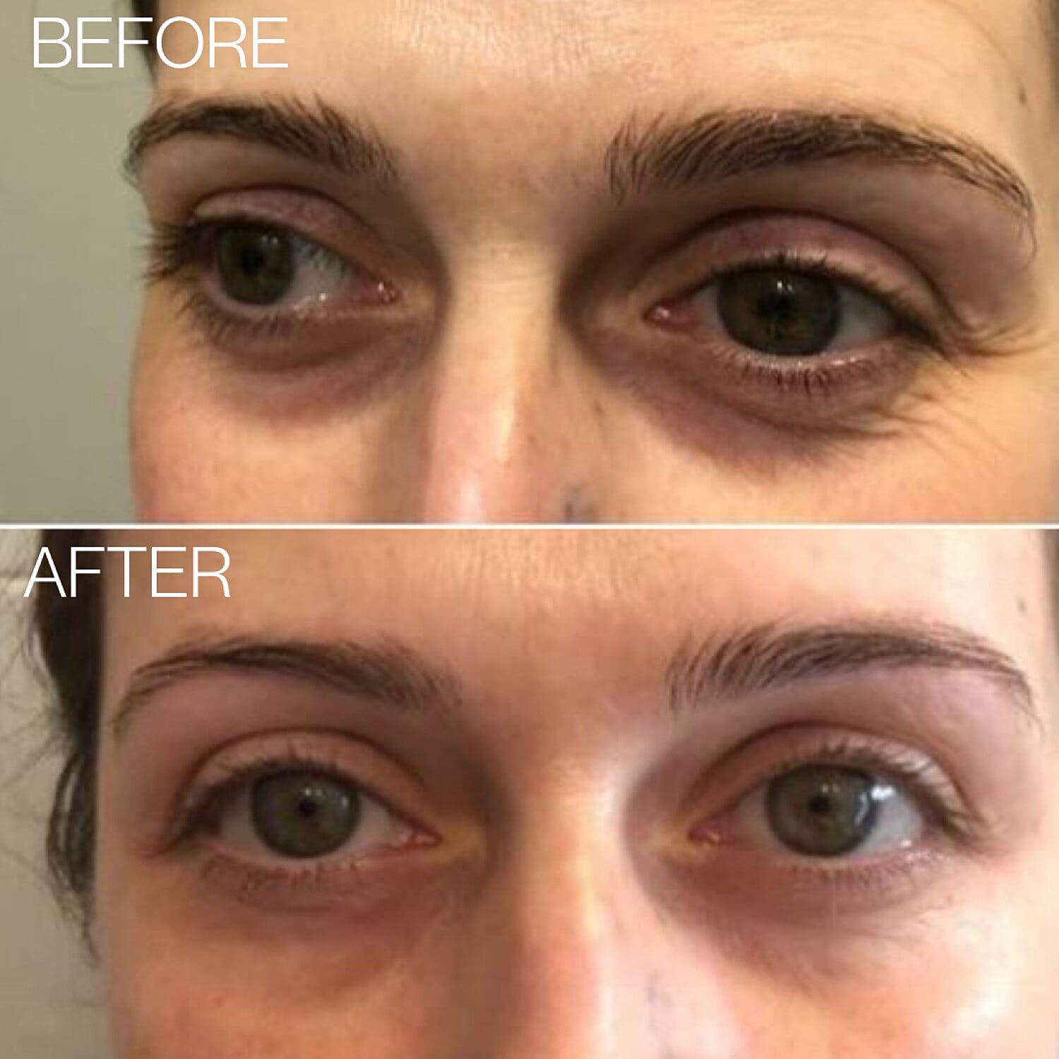 Beautical Microneedle Eye Patches