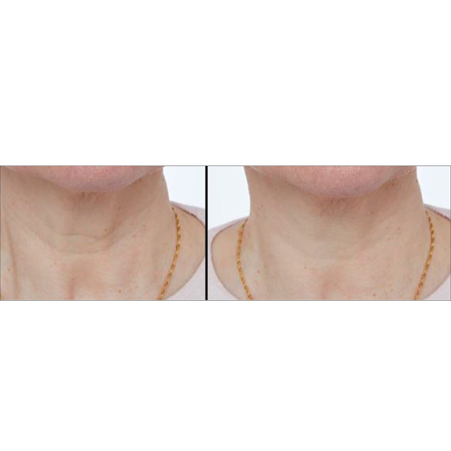 LAB LIFE - BEAUTY Body Device (Size 1x1 cm) - White