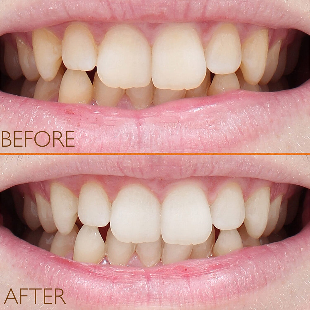 Lab Life Beauty Eclipse Teeth Whitening System