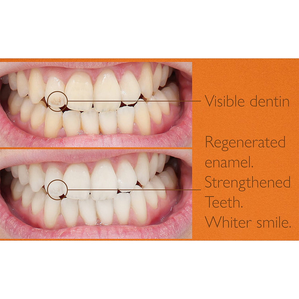 Lab Life Beauty Eclipse Teeth Whitening System