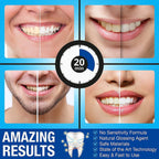 Pro Intellident Teeth Whitening Kit with LED Light